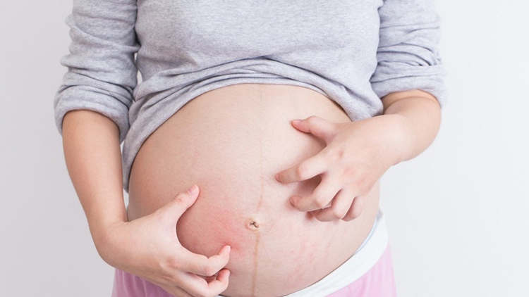 Nổi mề đay khi mang thai, bệnh không của riêng ai