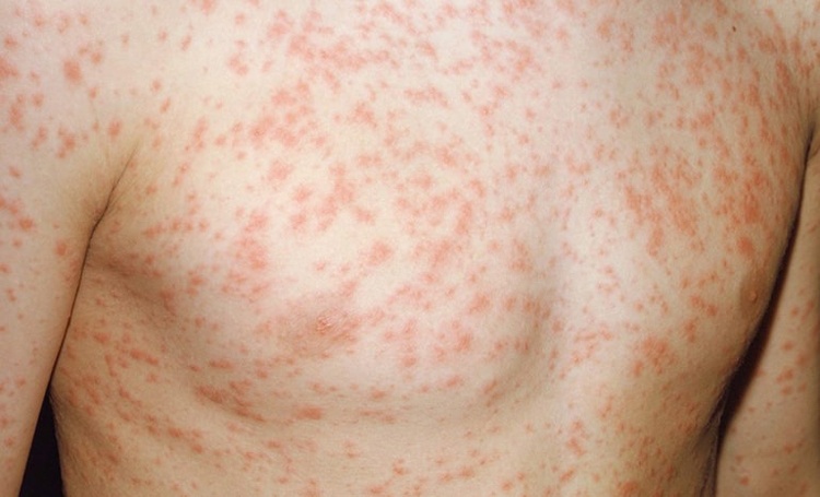 Bé bị nổi mẩn đỏ khắp người sau sốt là bệnh gì?