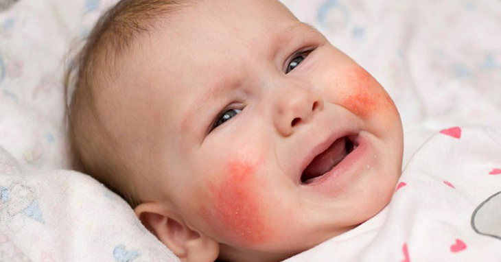 Viêm da tiết bã gây nổi mẩn đỏ ở trẻ sơ sinh