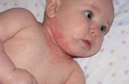 Trẻ sơ sinh bị nổi mẩn đỏ ở cổ