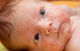 Trẻ sơ sinh bị nổi mẩn đỏ ở mặt