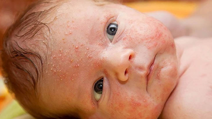 Trẻ sơ sinh bị nổi mẩn đỏ ở mặt