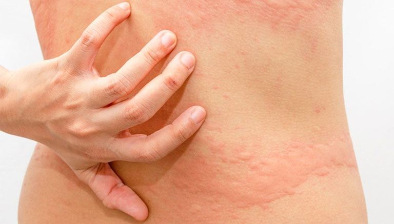 Mẩn ngứa nổi mề đay là bệnh lý phổ biến gây triệu chứng phát ban đỏ ngoài da