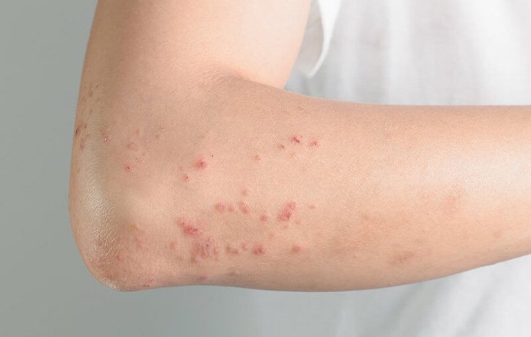 Viêm da, mề đay mẩn ngứa... là một trong những nguyên nhân phổ biến gây nổi mẩn đỏ, mẩn ngứa trên da
