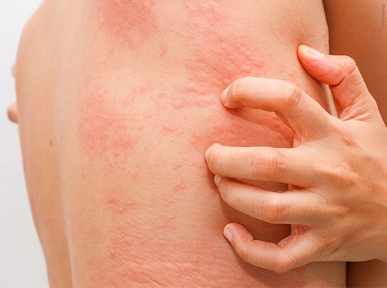 Mẩn ngứa mề đay là bệnh ngoài da do phản ứng viêm xuất tiết