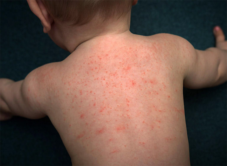 Nổi mẩn đỏ ngứa ở lưng là bệnh khá phổ biến