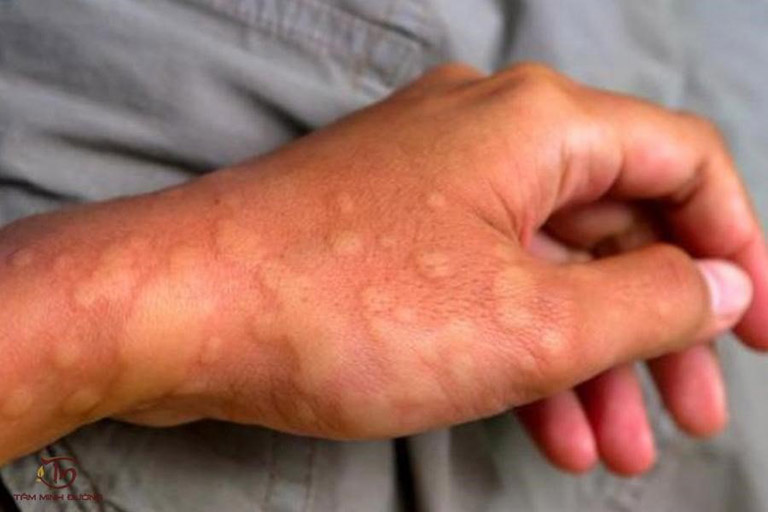 Nổi mẩn đỏ ở tay có thể xuất phát từ nguyên nhân người bệnh bị mề đay, mẩn ngứa