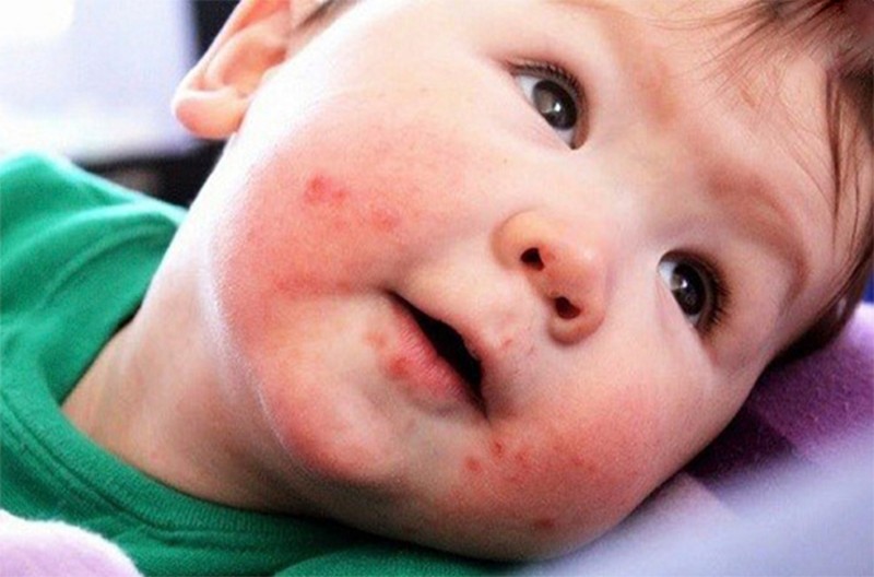 Trẻ bị nổi mẩn đỏ xung quanh miệng là bệnh gì?