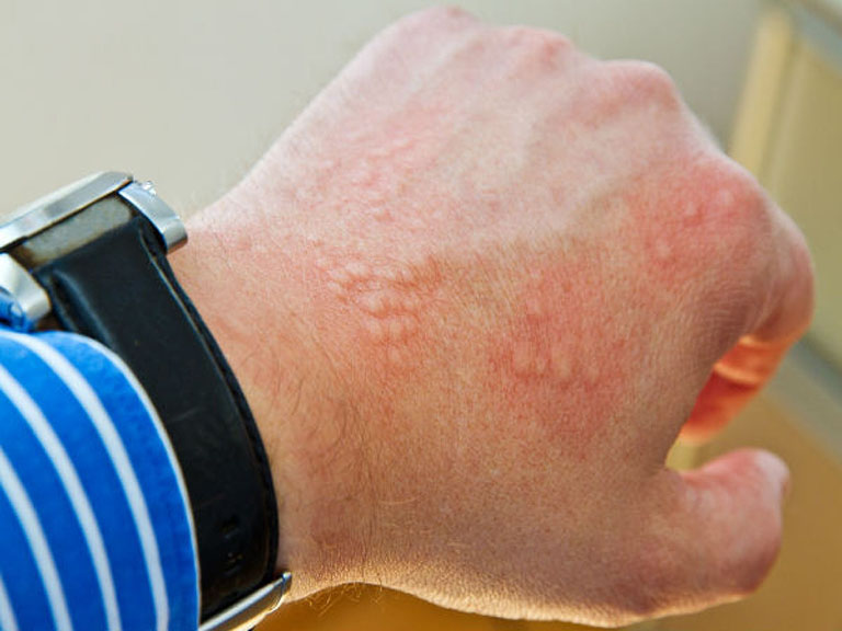 Nổi mẩn đỏ ở tay có thể xuất phát do bệnh mề đay, mẩn ngứa