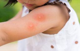 Nhiều trẻ bị nổi mẩn ngứa khó chịu trên da